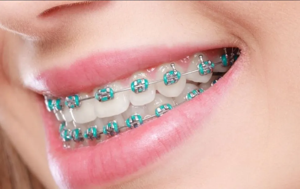 5 Common Myths About Orthodontic Treatment Debunked 5 Common Myths About Orthodontic Treatment Debunked