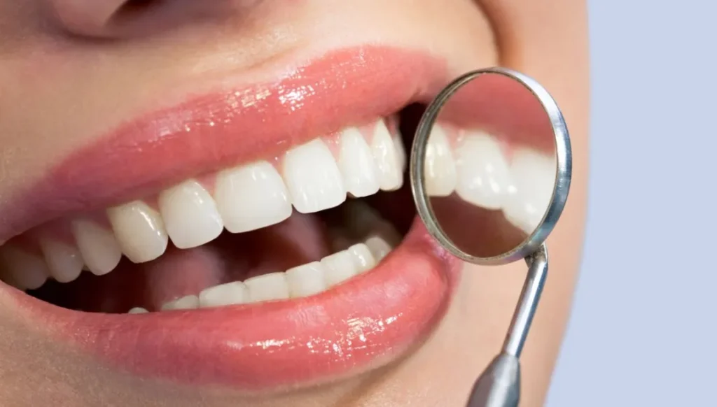 5 Tips To Keep Dental Bonding From Staining 5 Tips To Keep Dental Bonding From Staining