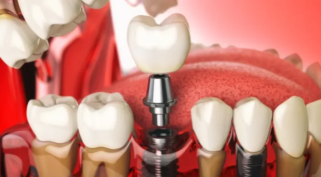 Combining Periodontal And Implant Dentistry For Complete Oral Rehabilitation Combining Periodontal And Implant Dentistry For Complete Oral Rehabilitation