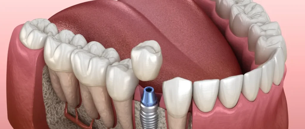 How Bone Density Affects Dental Implant Planning